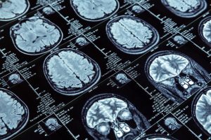Diagnostik bei Parkinson-Syndromen